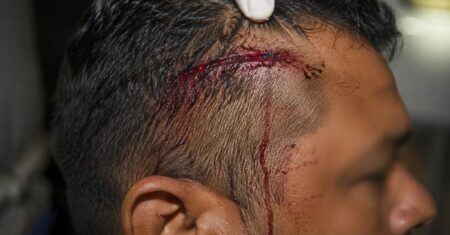 Homem escapa de seqüestradores após ser torturado e atingido por tiro de raspão na cabeça