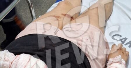 Mulher é atacada por cão durante passeio e sofre mordidas pelo corpo em Rondonópolis; imagens