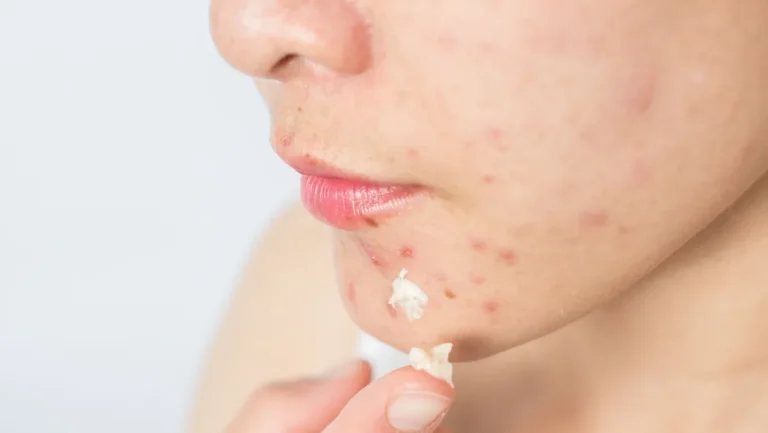 Jovens recorrem ao Tiktok para tratar acne e ignoram dermatologistas